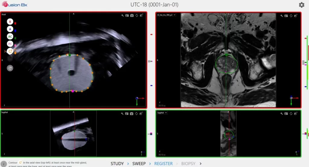 Screen capture from Fusion Bx software- segmenting live ultrasound