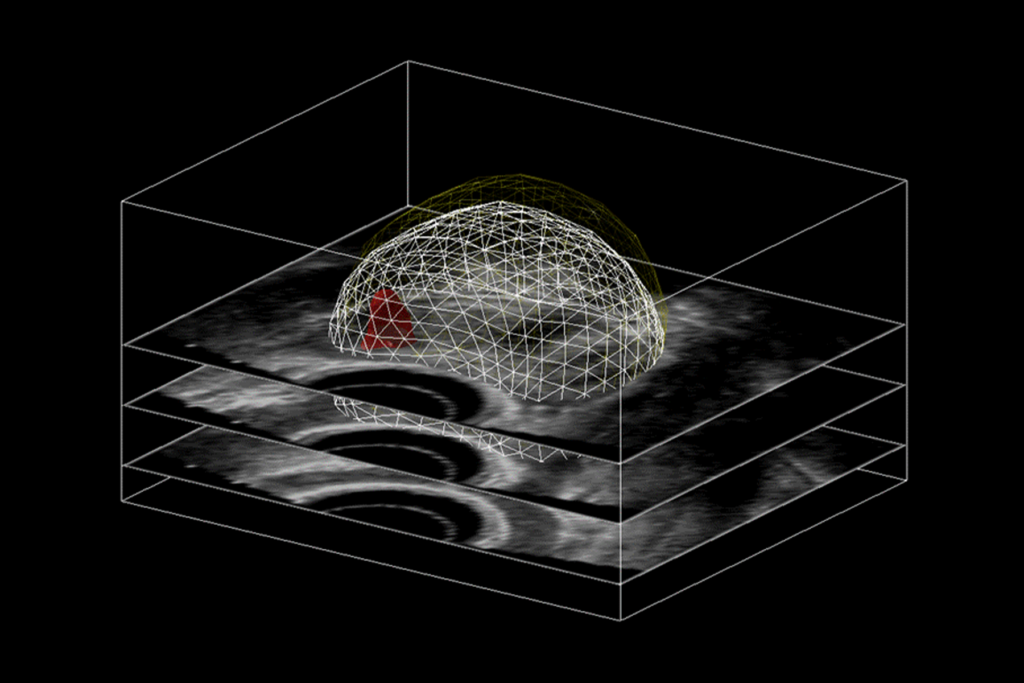 prostate MRI slices overlaid on 3D reconstruction