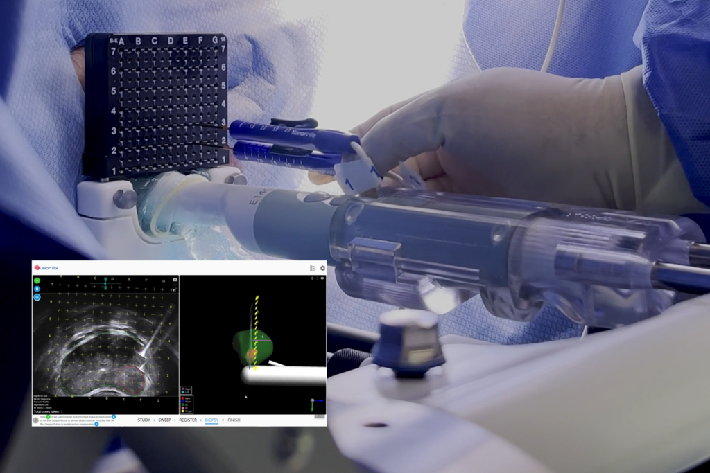 IRE Nanoknife needle insertion