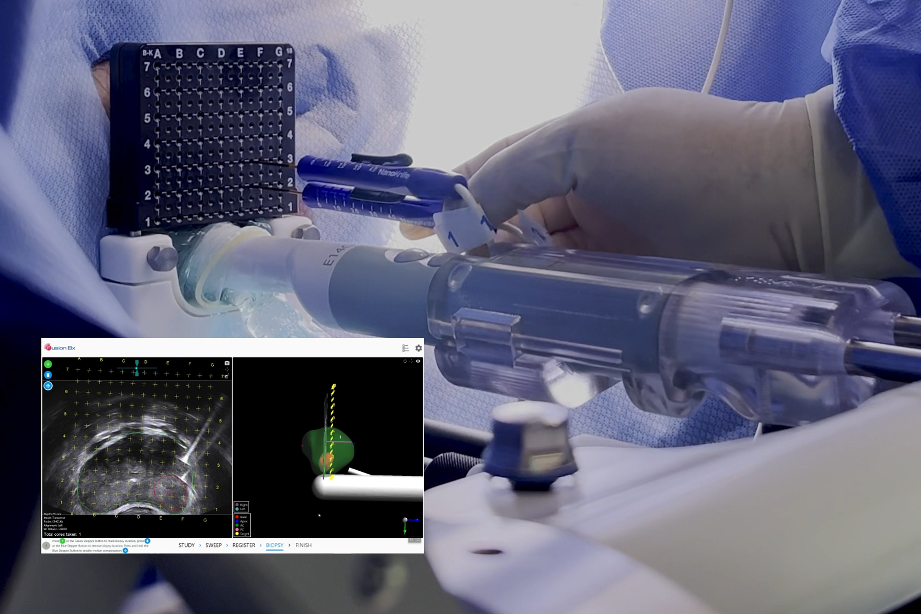 IRE Nanoknife needle insertion