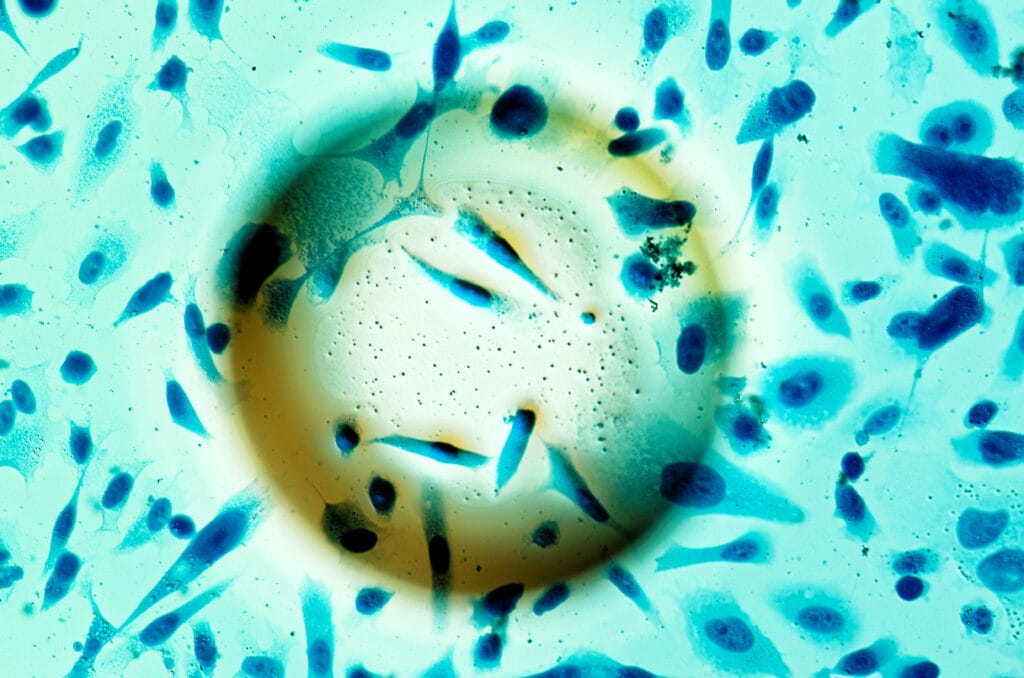 PC-3 human prostate cancer cells in air bubble, stained with Coomassie blue, under differential interference contrast microscope.